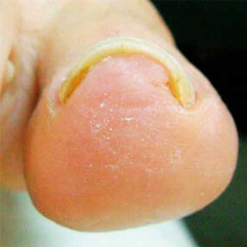 巻き爪補正 after