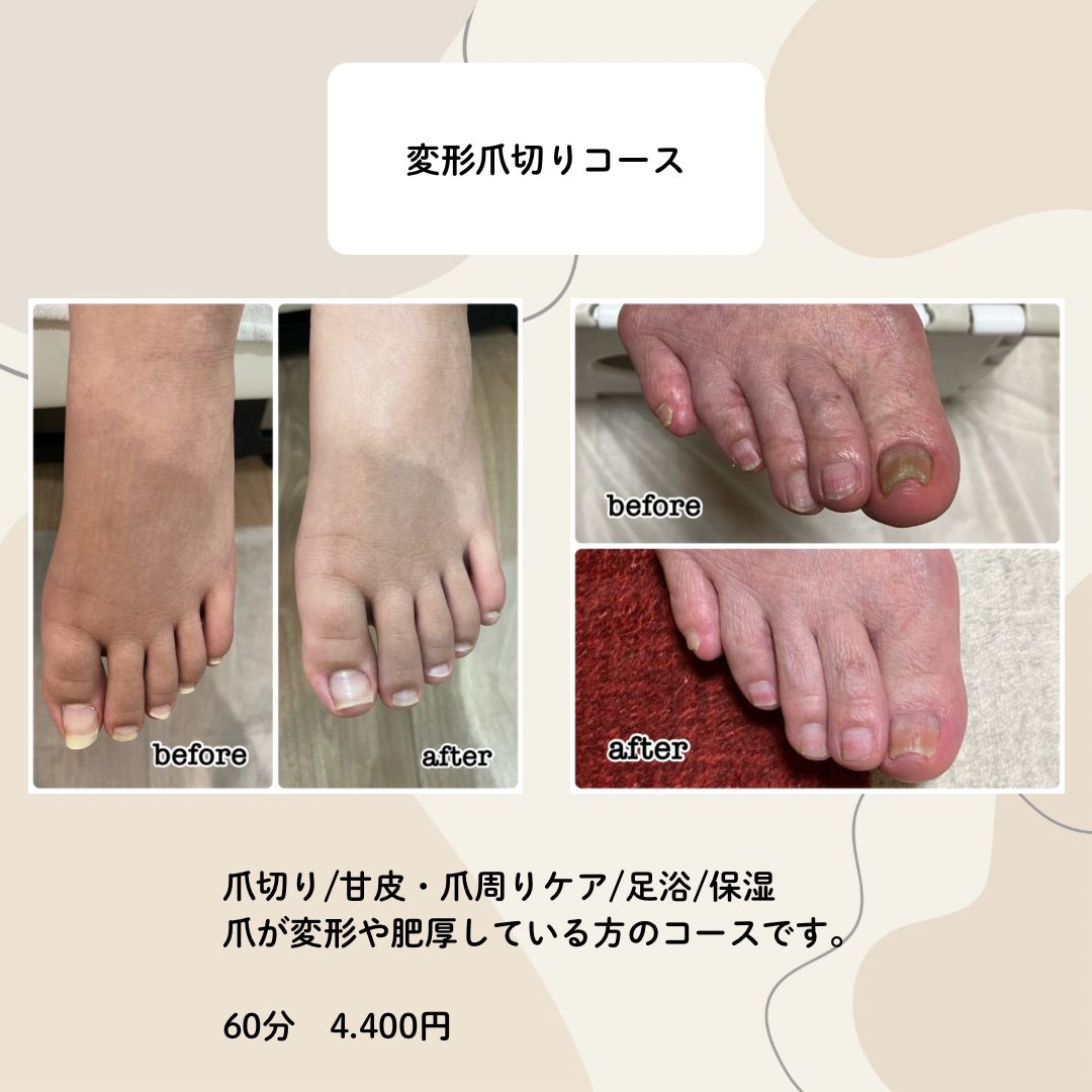 変形爪切りコース