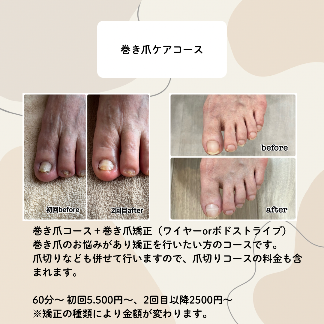巻き爪ケアコース