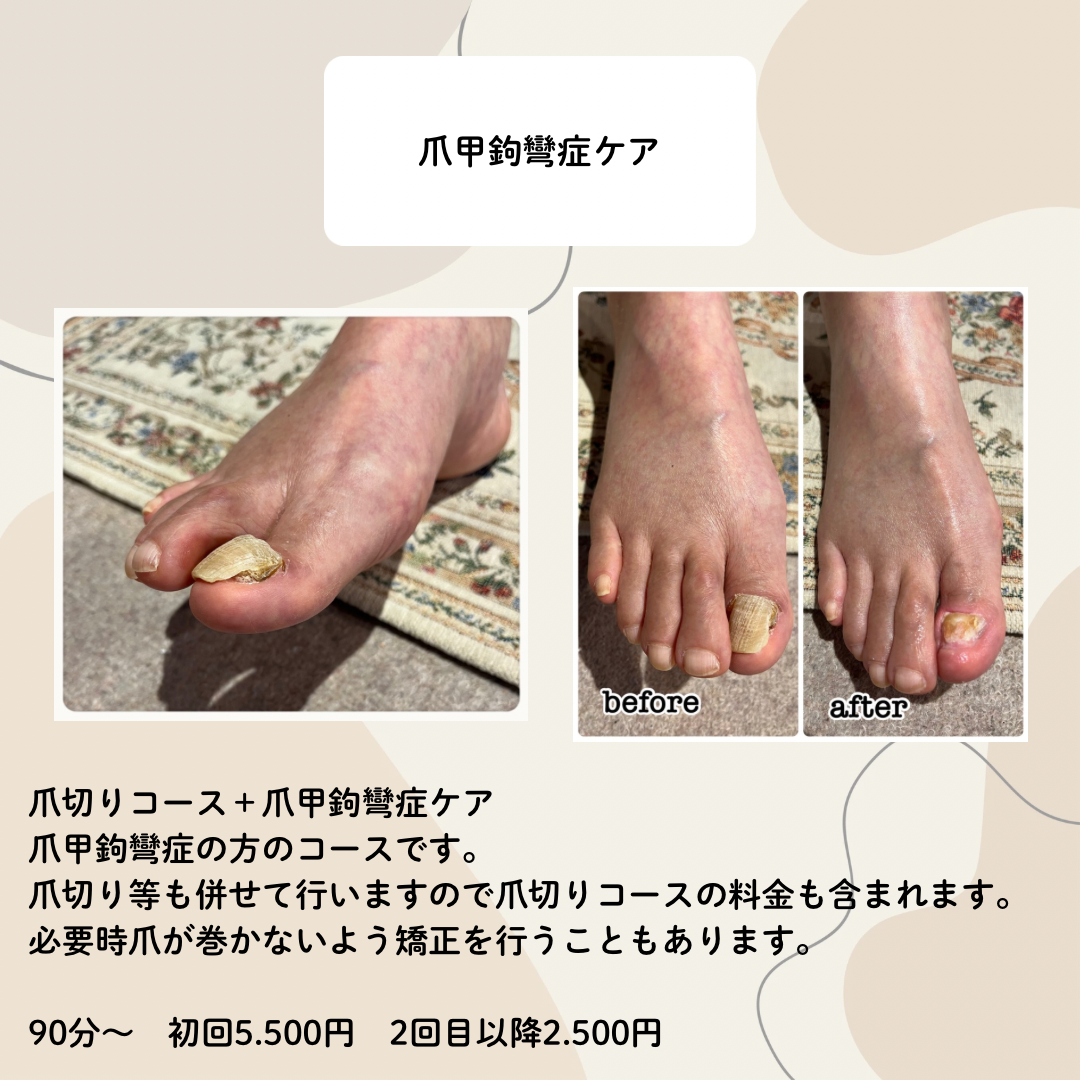 爪甲鉤彎症ケアコース