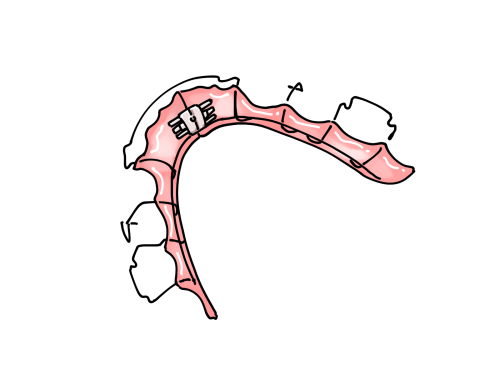拡大床