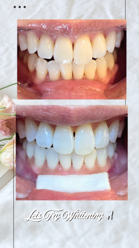 Lets Whitening 🦷_20251007_064331_0000.png