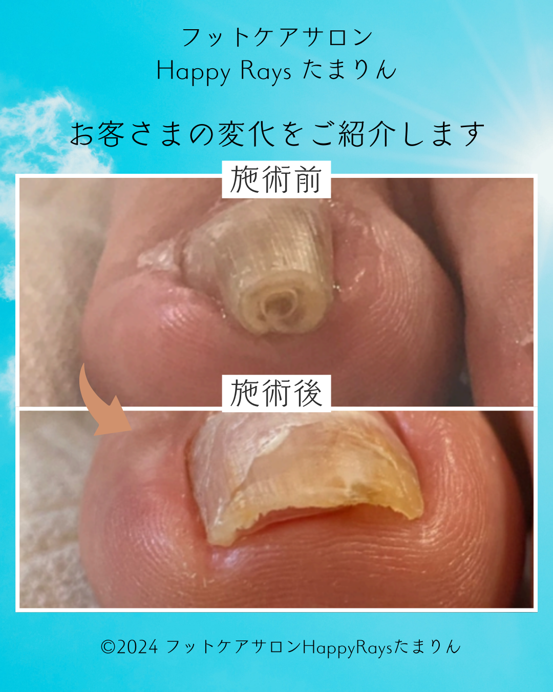巻き爪解放（親指1本）　30分