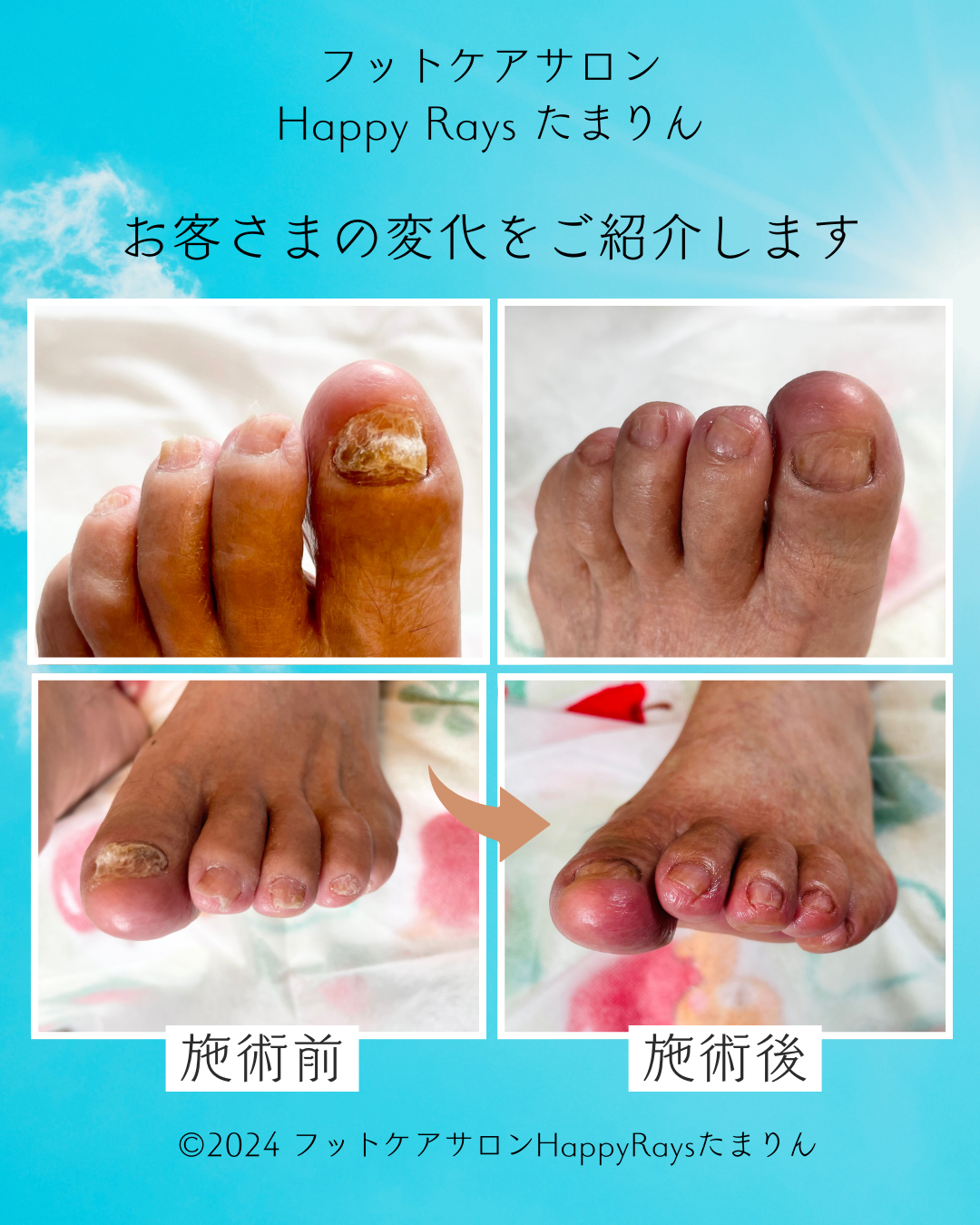 爪ケア（中～重度）　60分