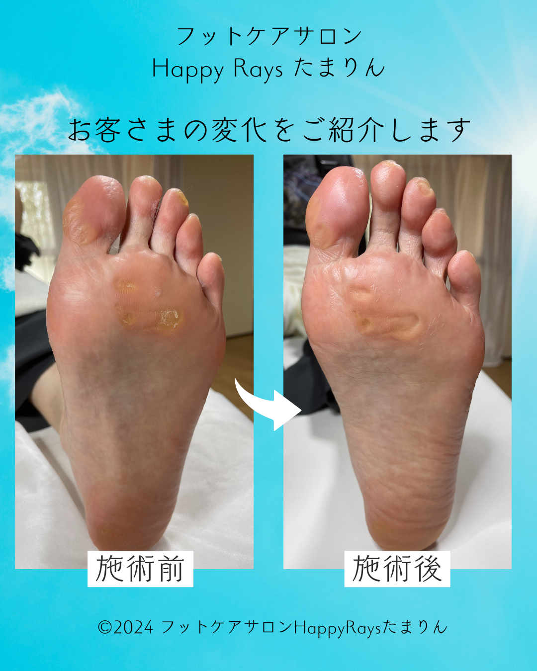 タコ・魚の目ケア（中～重度）　60分