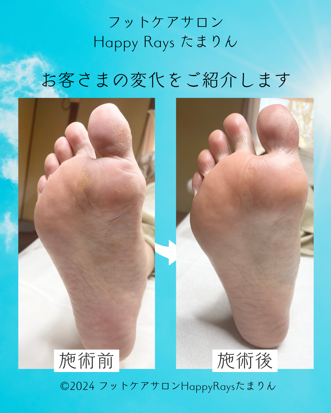 足裏角質ケア　30分