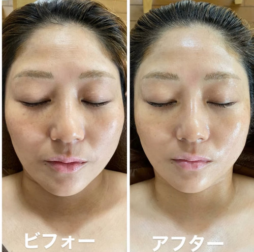 美女がヒト幹細胞尽くしで艶肌超絶美女に！
