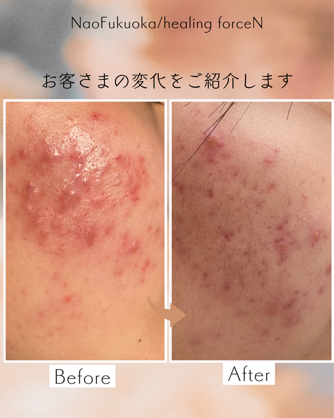 新春！ハーブピーリング期間限定価格！