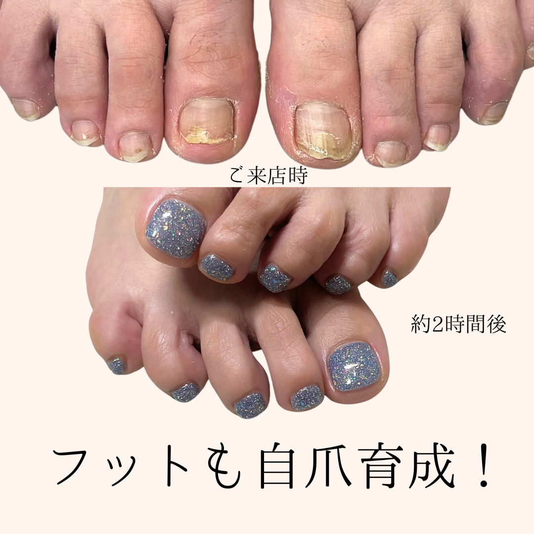 [foot]自爪育成