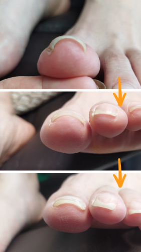 症例ハイライト - 28.png