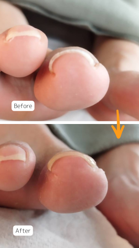 巻き爪ケア