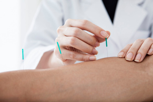acupuncture_G_542565496.jpg
