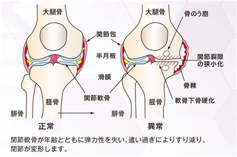 変形性膝関節症.png