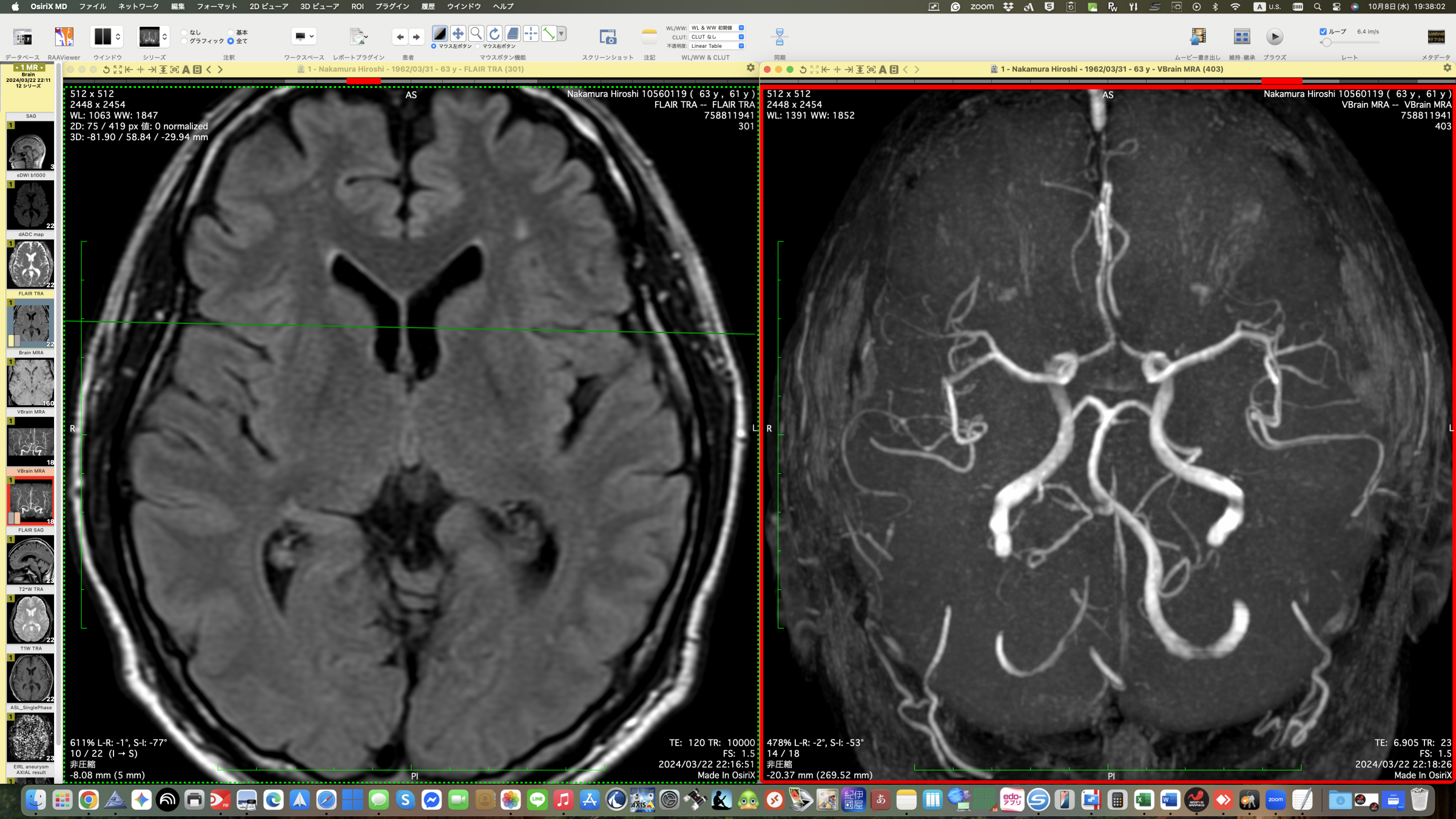 Advanced neuroimaging for a precise and comprehensive diagnosis