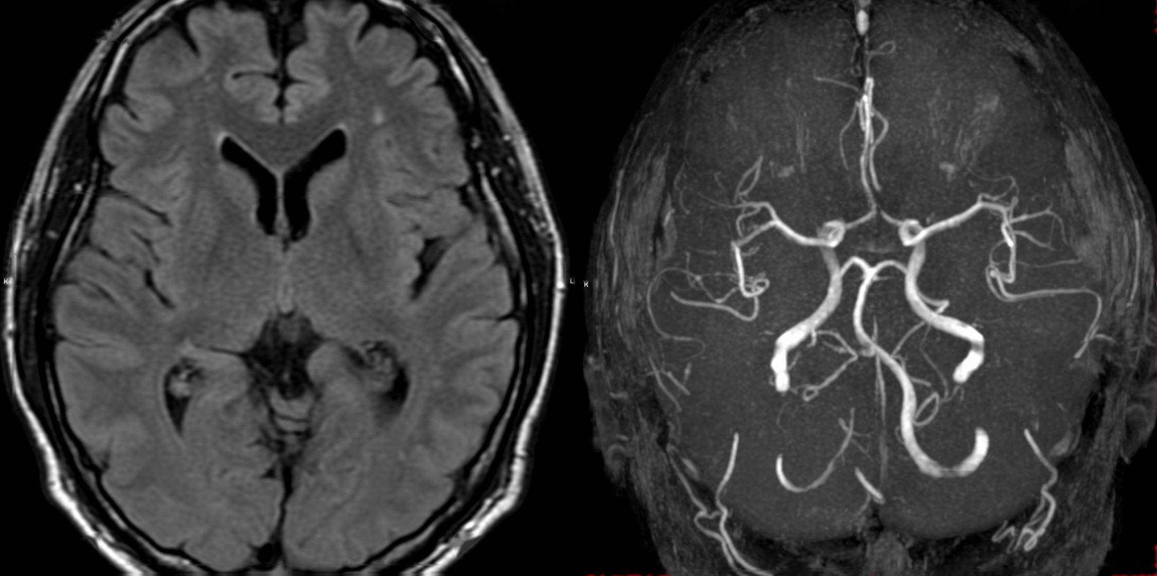 Advanced neuroimaging for a precise and comprehensive diagnosis