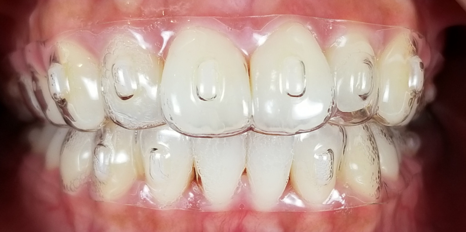 自由診療 被せ物 詰め物 入れ歯 矯正 ホワイトニング マウスピース矯正 スマイル歯科 Smile Dental Clinic