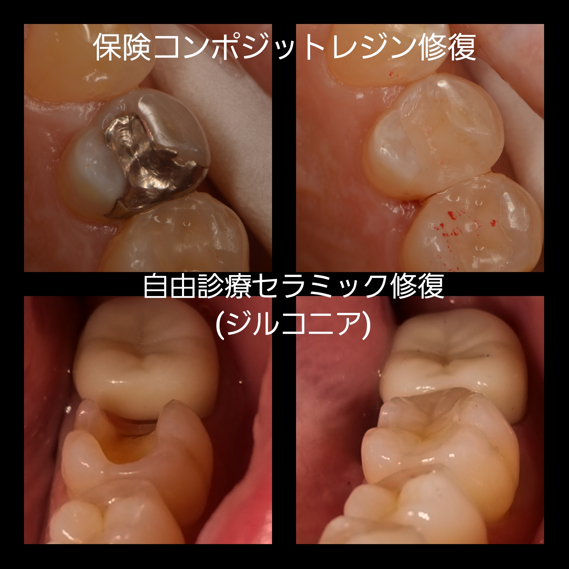 銀歯のデメリット - Smile Dental Clinic