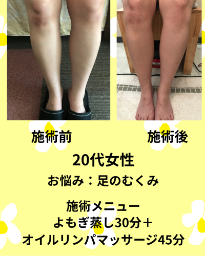 むくみ前後.png