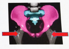骨盤　矯正図.jpg