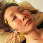 美容鍼.png