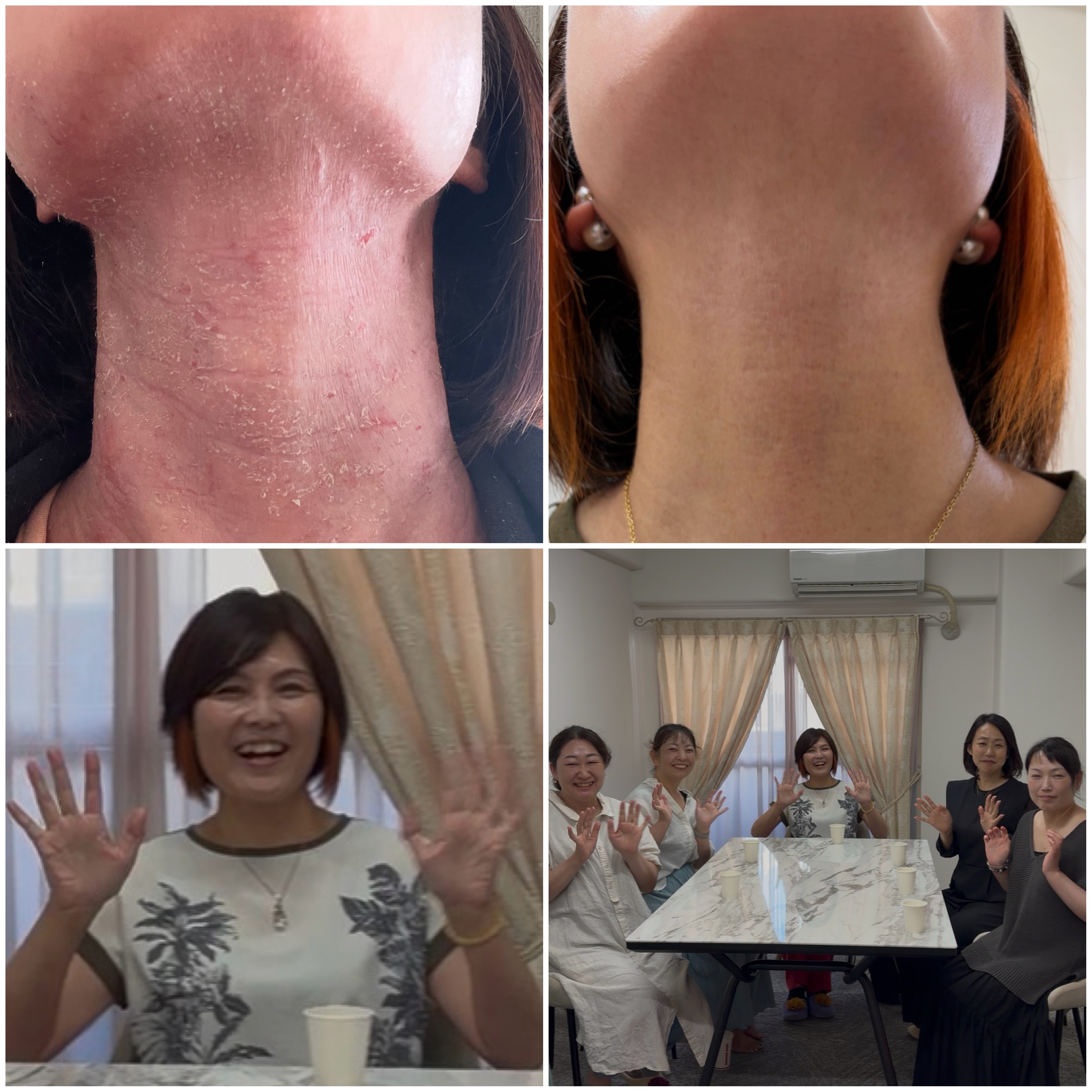 アトピー性皮膚炎の寛解