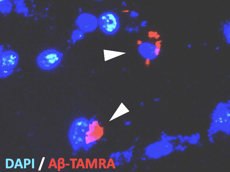 アミロイドβを貪食したミクログリア