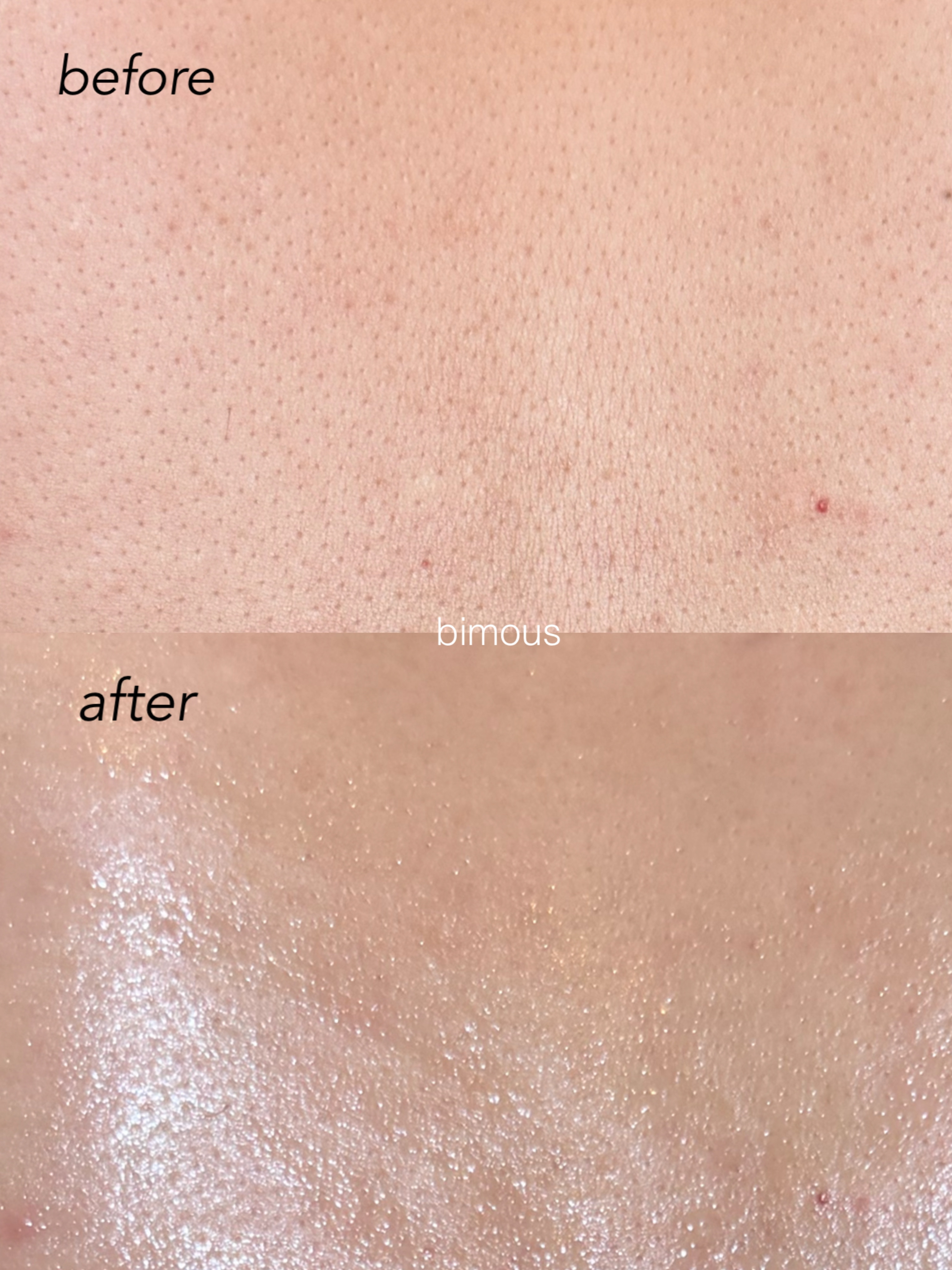 背中の毛穴洗浄（ハイドロスプラッシュ）