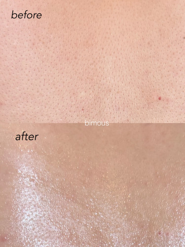 背中の毛穴洗浄（ハイドロスプラッシュ）