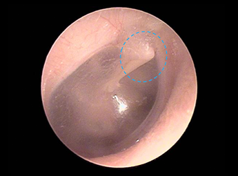 endoscope-ear19.png