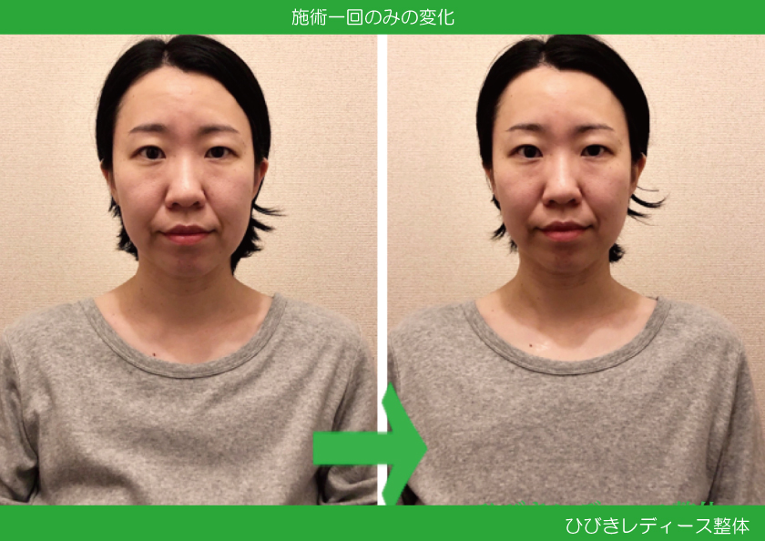 産後の小顔矯正 横浜市港北区 日吉の産後専門 ひびきレディース整体