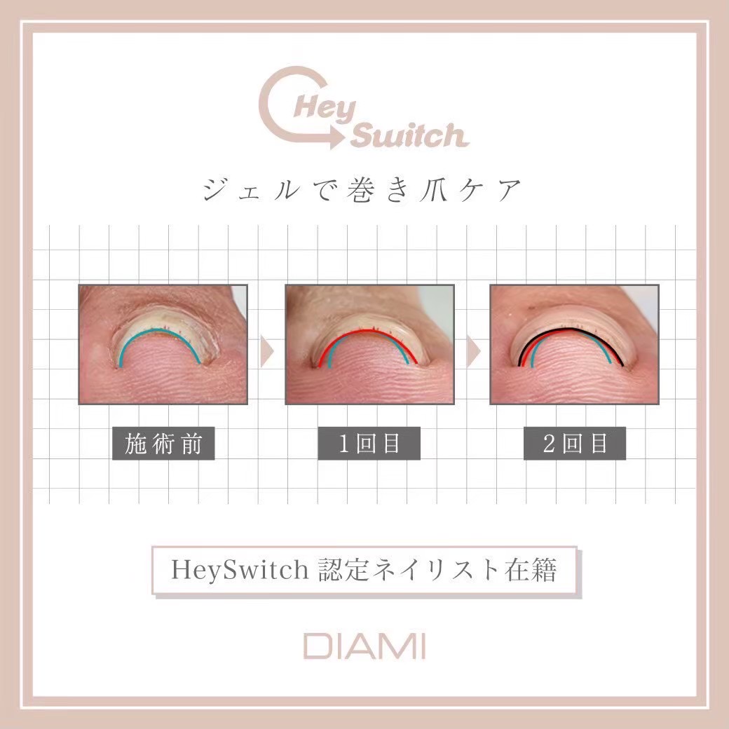 巻き爪ケア（HeySwitch）１本