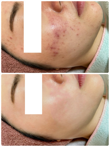 ニキビビフォ・アフター.jpeg