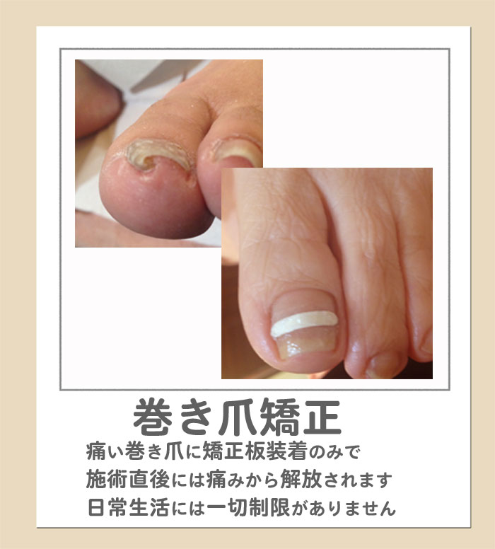 ホームページ使用巻き爪矯正.jpg