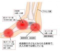足の成長痛.png