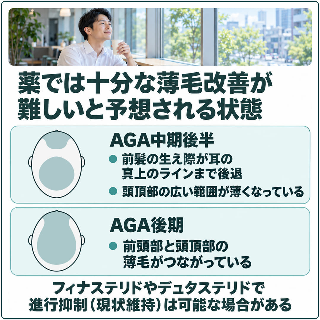 薬では十分な薄毛改善が難しいと予想される状態の模式図。AGA中期後半と後期で薄くなる範囲を示し、フィナステリドやデュタステリドで進行抑制は可能な場合があると添える
