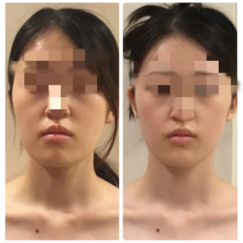 全身の鍼だけで顔が若返る理由｜鍼灸治療と自律神経・骨格筋・心の関係