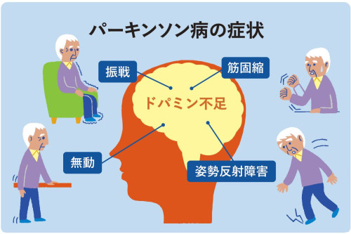 パーキンソン.jpg