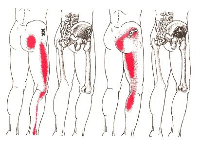 トリガーポイント坐骨神経痛