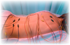 座骨神経痛の鍼治療、電気鍼イメージ