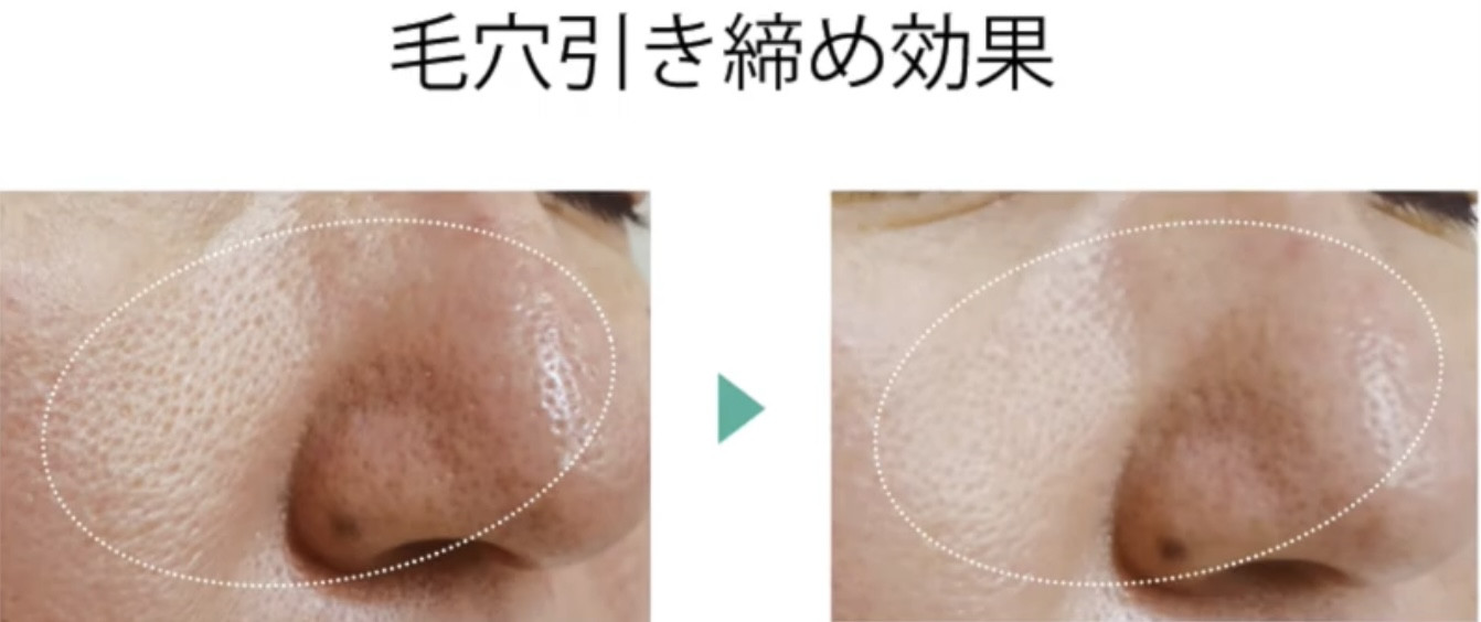 夏に目立つ毛穴ケア