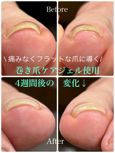 巻き爪ケアジェル