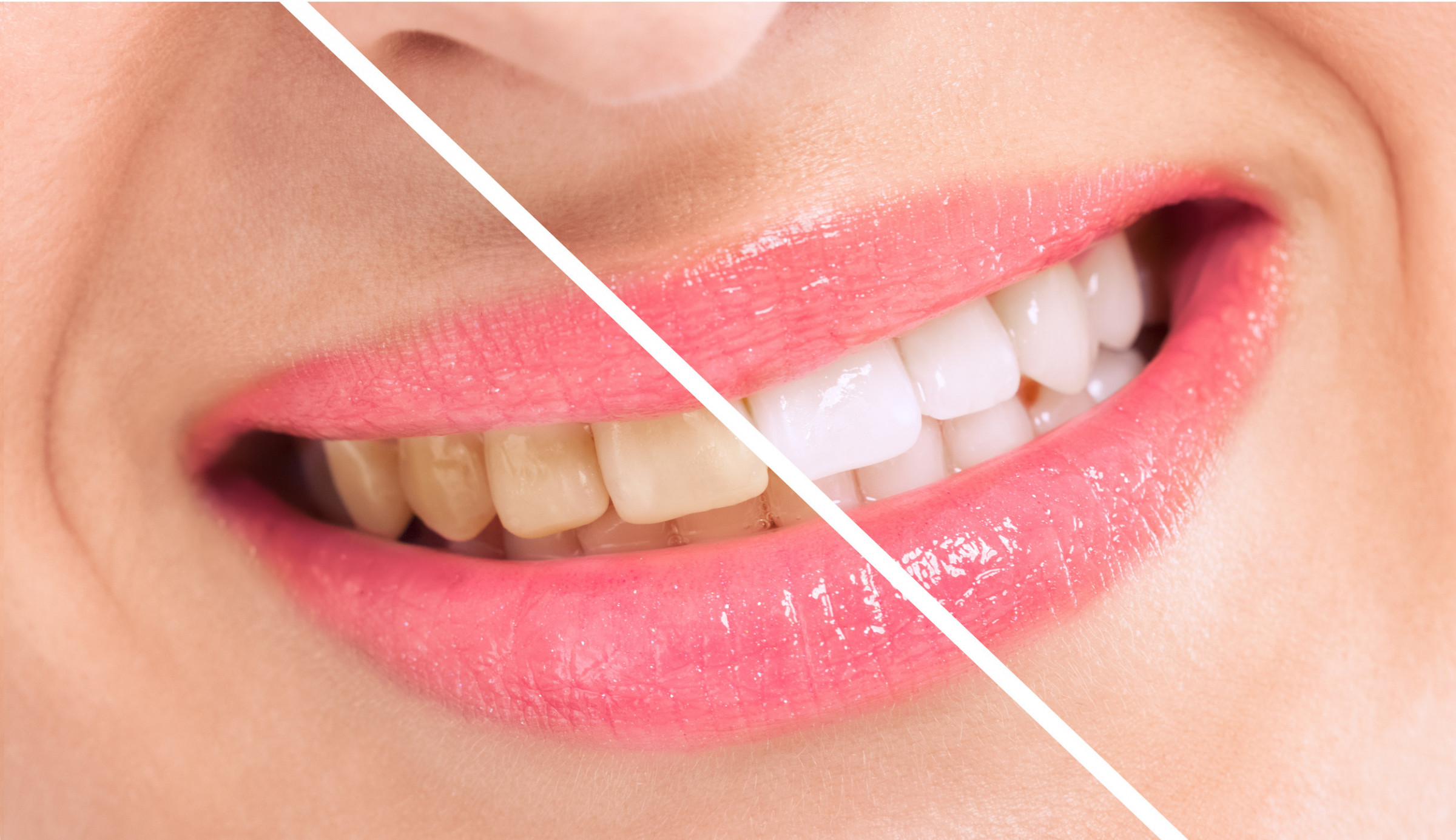 審美歯科：被せ物の色調や形が気になる　歯の色を白くしたい　金属色の被せ物や詰め物を白くしたいなどのご要望があればお聞かせください。