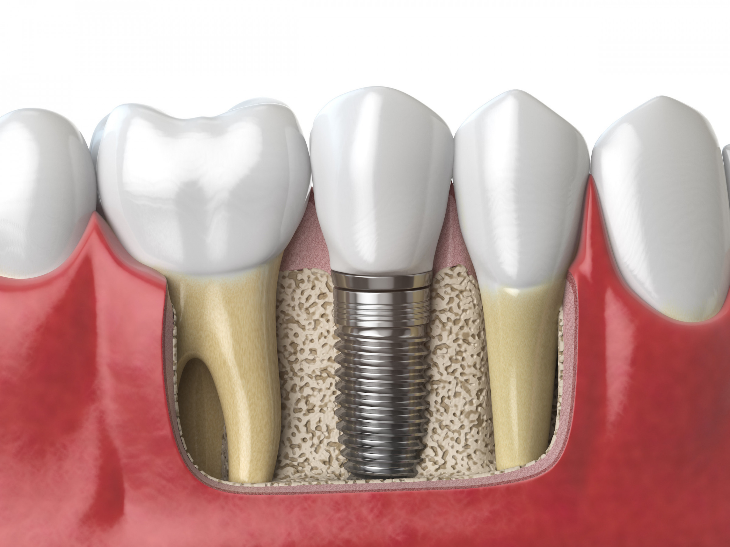 インプラント治療： 歯を失った部分に歯を入れたい　入れ歯ではなく天然歯のような歯にしたい　失った歯の隣の歯を削りたくない　などお困りのことがあればご相談ください。