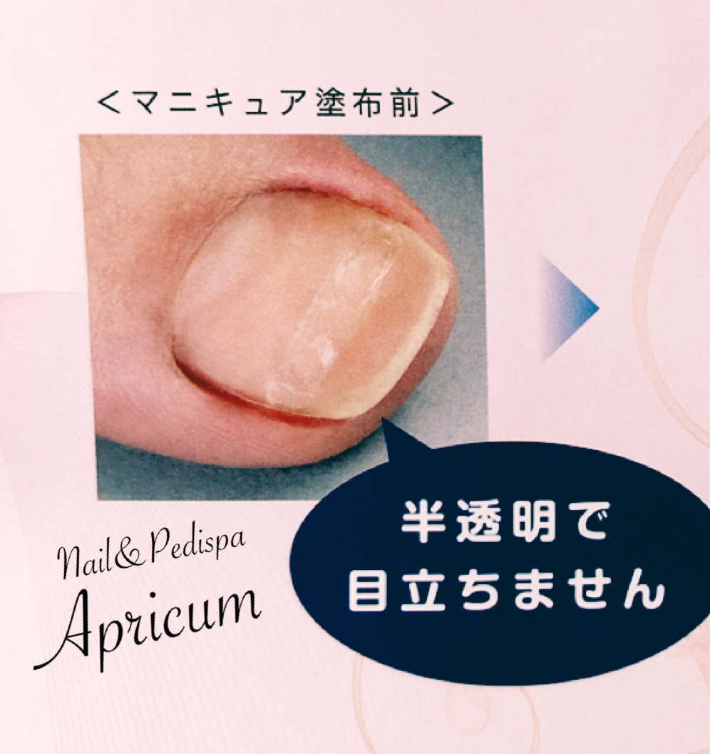 巻き爪矯正（B/Sブレイスクイック） - Nail&Pedispa Apricum Toyota