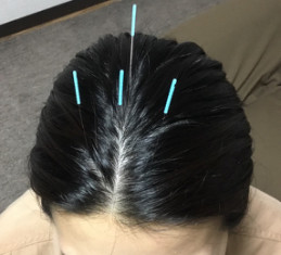 頭皮鍼1.png