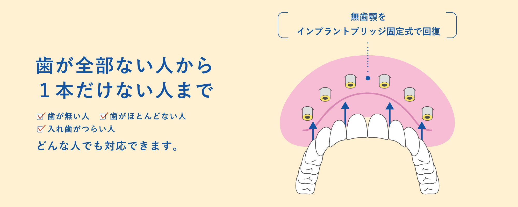 歯が全部ない人から1本だけない人まで、どんな人でも対応できます。