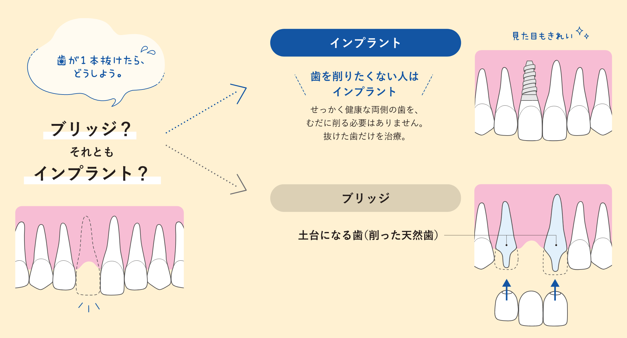 歯が1本抜けたらどうしよう。ブリッジ？それともインプラント？歯を削りたくない人はインプラント。