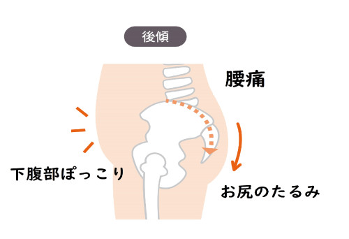 骨盤後傾.jpg