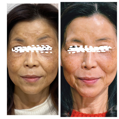 肝斑，そばかすケア