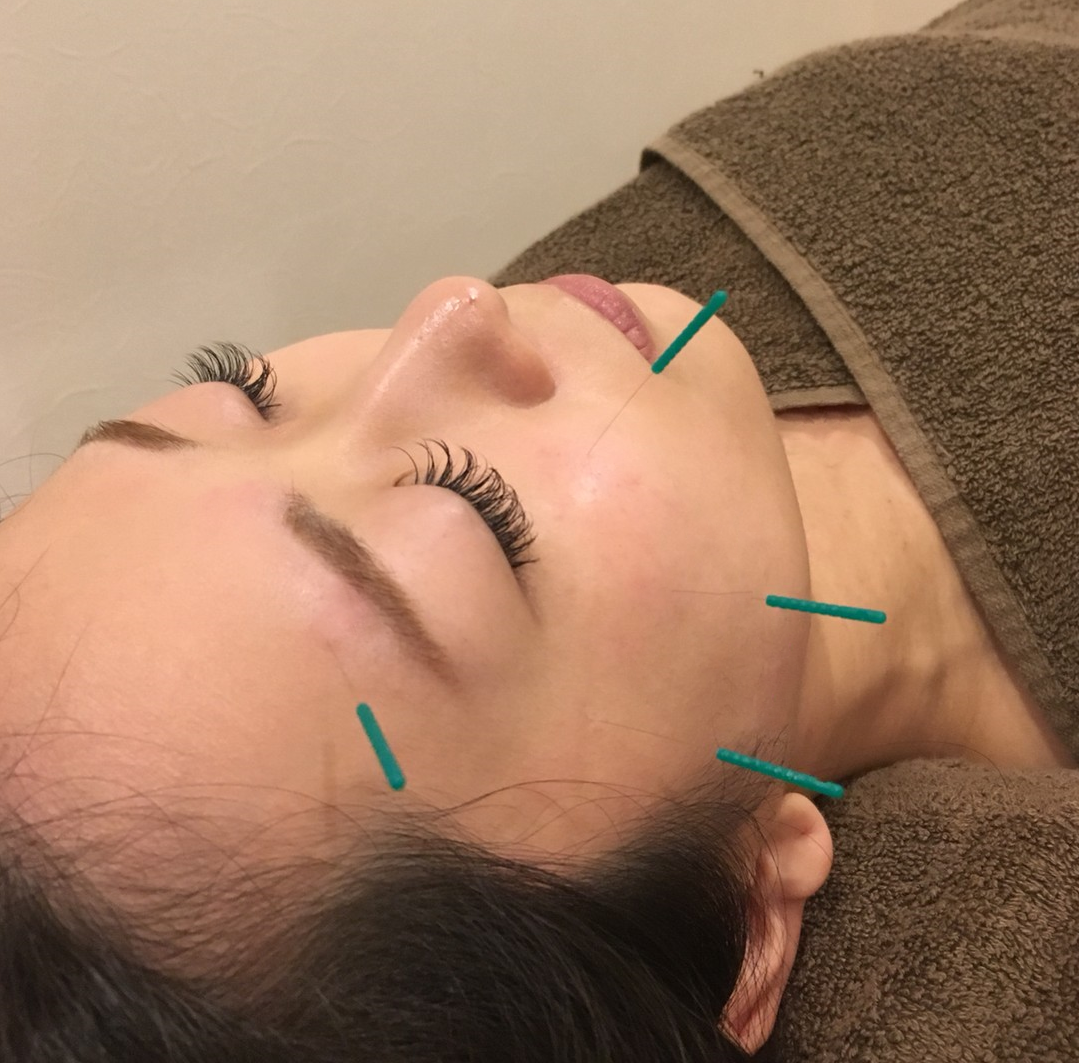 メニュー 美容鍼 Sunplus等々力鍼灸院 等々力のnew鍼灸 マッサージ院